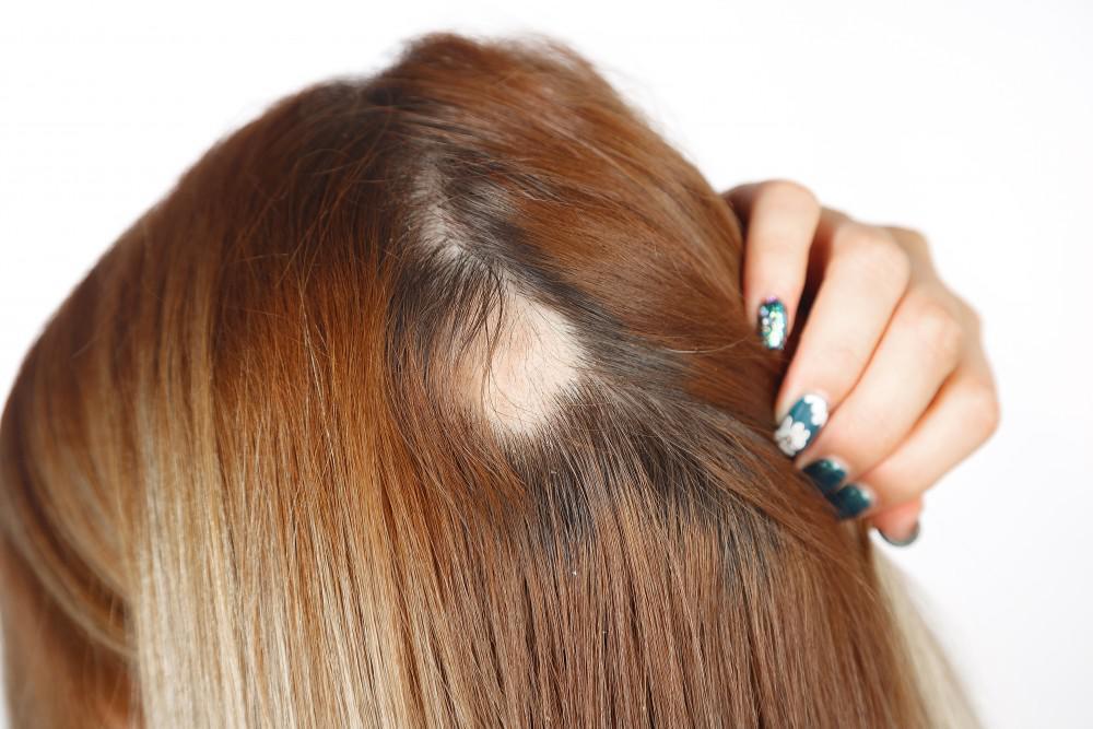 woman's alopecia