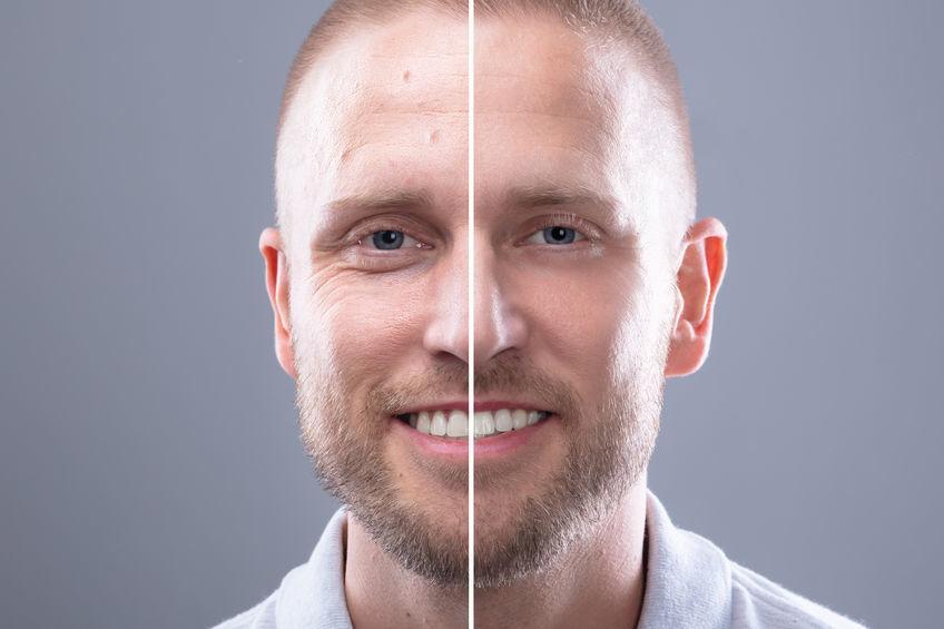 Man's facial skin condition before and after