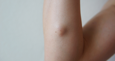 Epidermoid Cysts