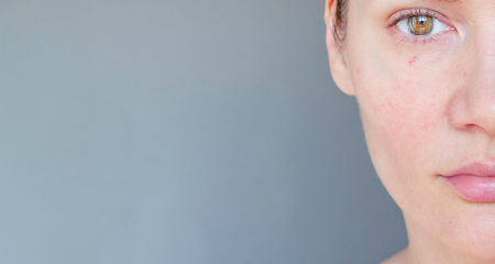 Rosacea