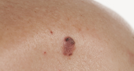 Melanoma