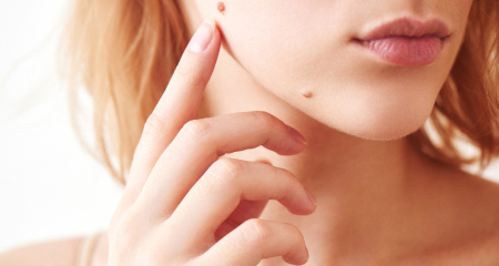 Mole Removal