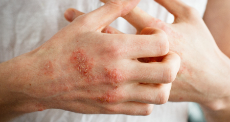 Eczema