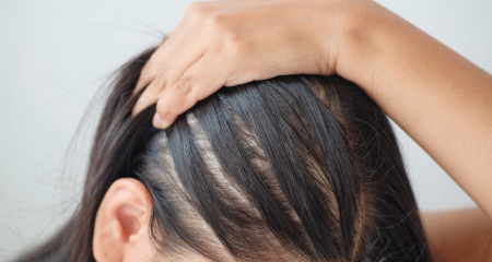 Alopecia (Hair Loss)