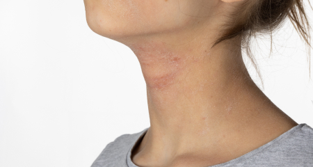 Hives