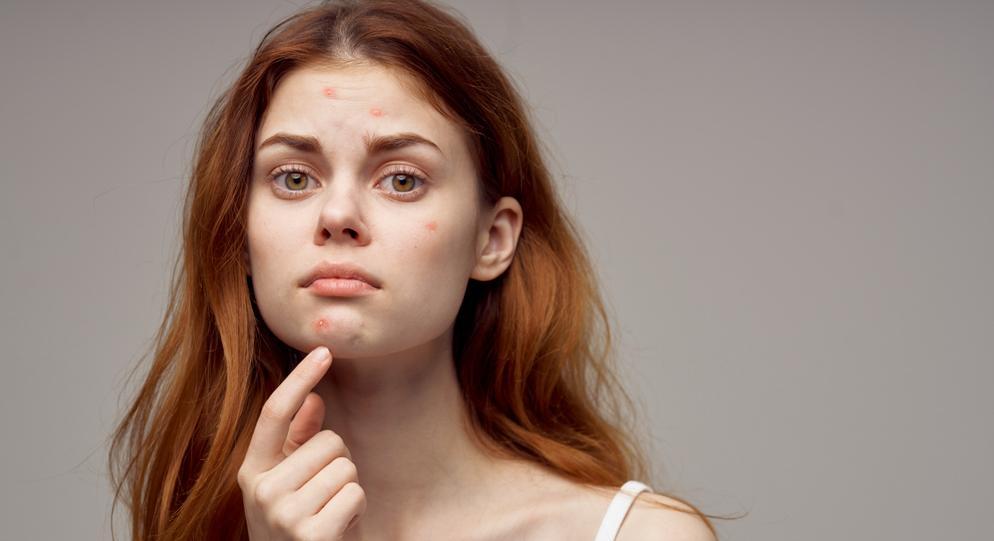 girl with acne
