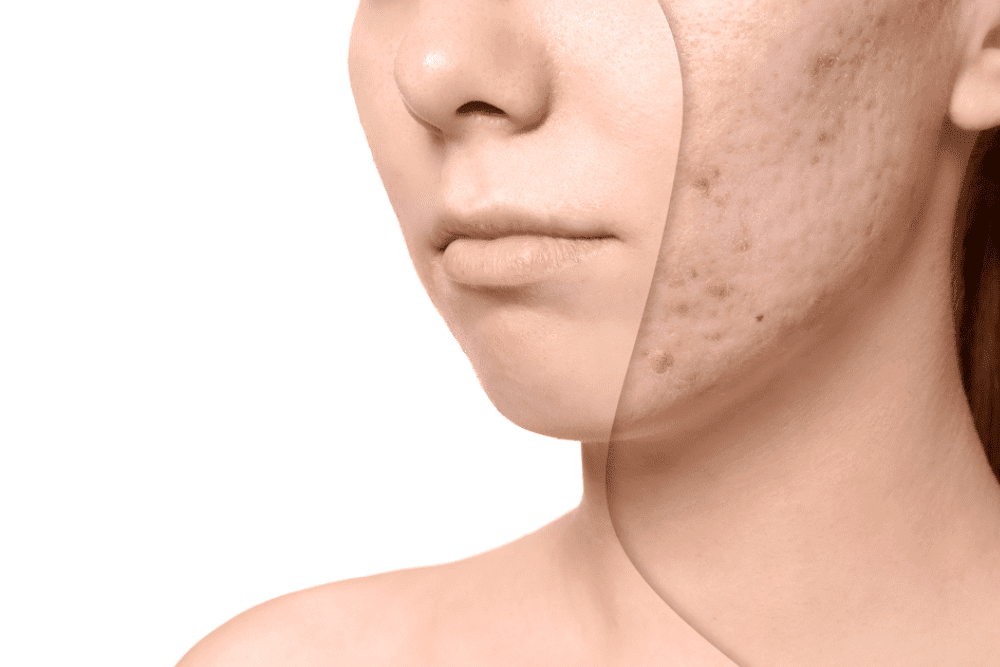 acne scars