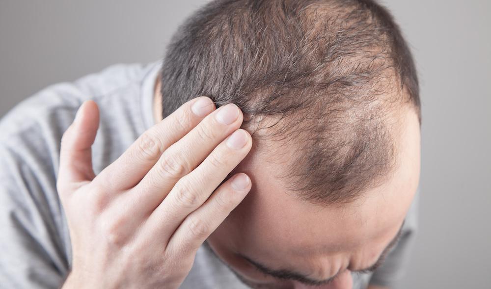 male hair loss