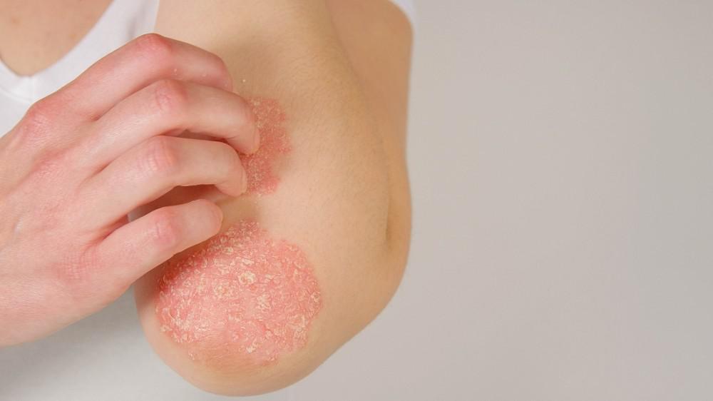 psoriasis