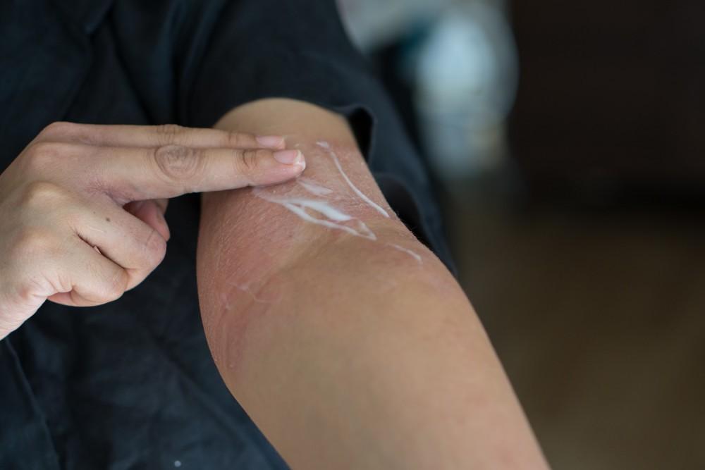 eczema
