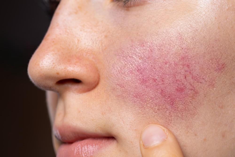 We Can Help You Get Rid Of Rosacea Northstar Dermatology 