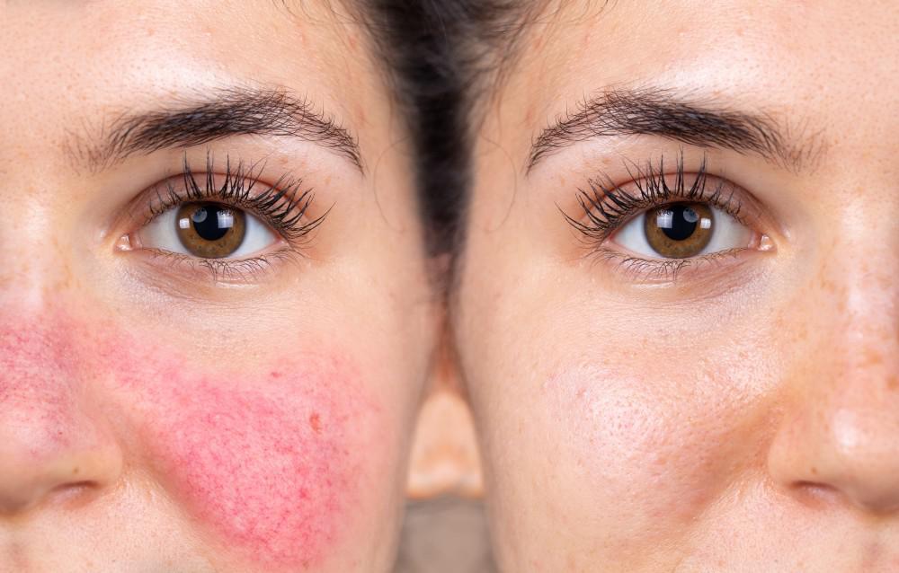 rosacea