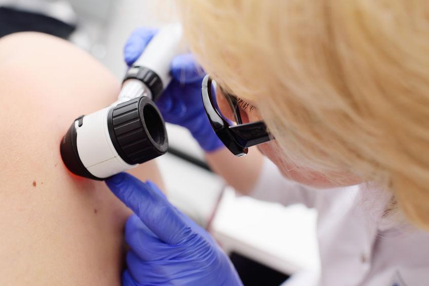 skin tag removal