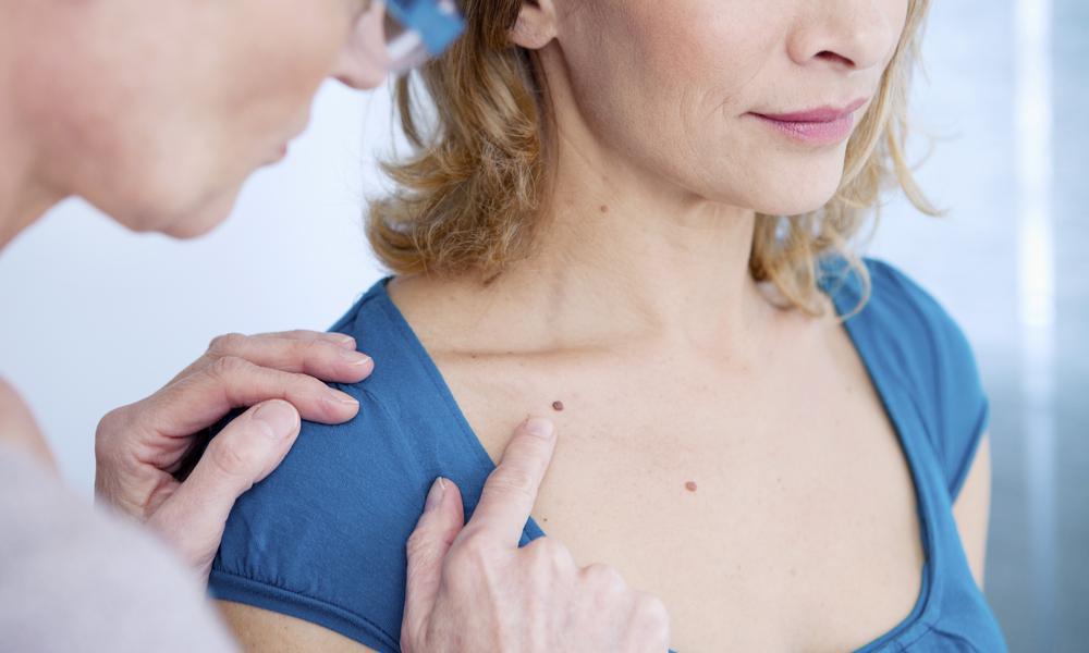 mole treatment