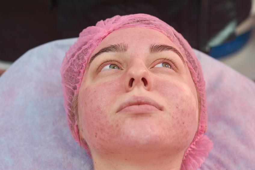 Woman with acne