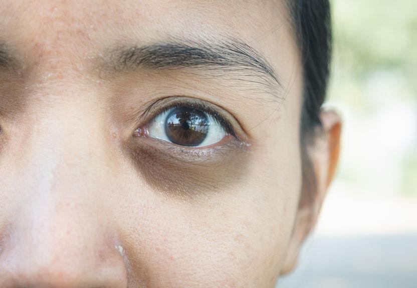 dark circles