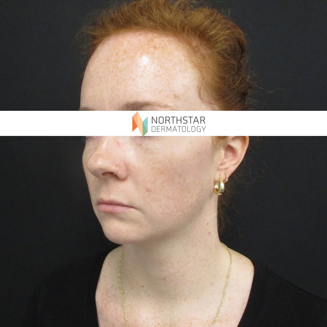 Northstar New pt 3
