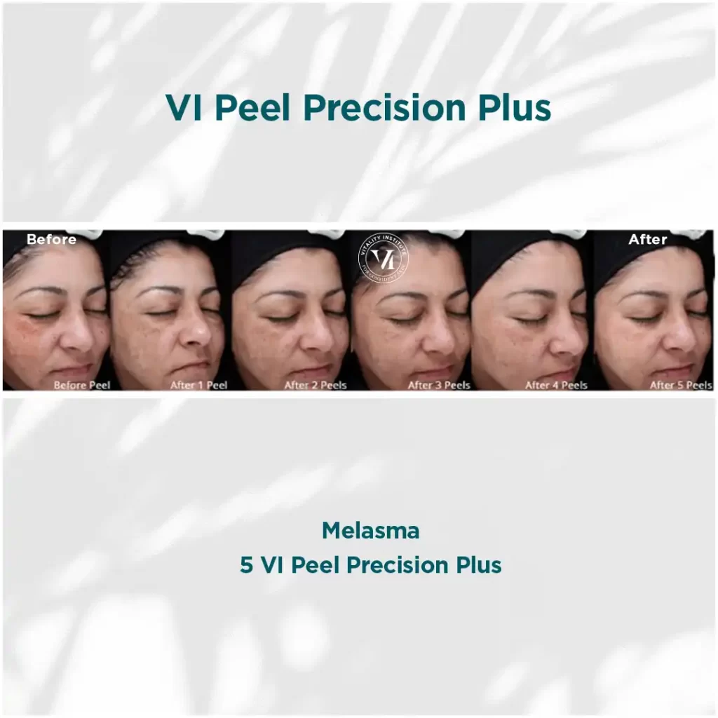 VI Chemical Peels